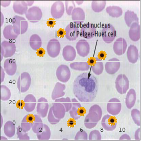 Mental retardation u   Mental retardation x