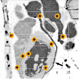 Nasodigitoacoustic syndrome