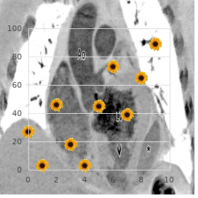 Exostoses anetodermia brachydactyly type E