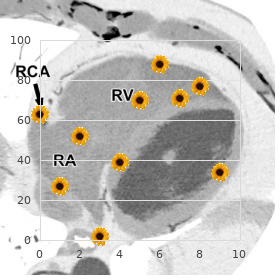 Multifocal motor neuropathy