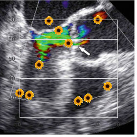 Trichorhinophalangeal syndrome type III