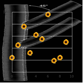 Knuckle pads, leuconychia and sensorineural deafness