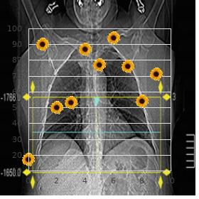 Aloi Tomasini Isaia syndrome