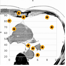 Esthesioneuroblastoma