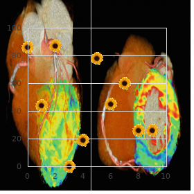 Rasmussen Johnsen Thomsen syndrome