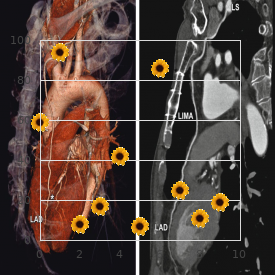 Chromosome 7, monosomy 7q2