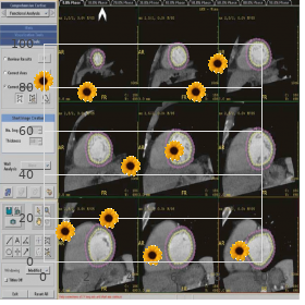 Microcephaly chorioretinopathy recessive form