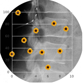 Chromosome 13, partial monosomy 13q