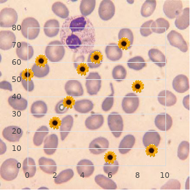 Telecanthus with associated abnormalities