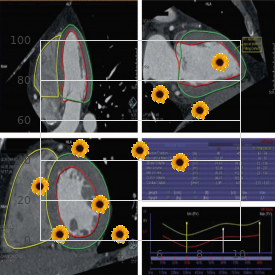 Deafness, X linked, DFN