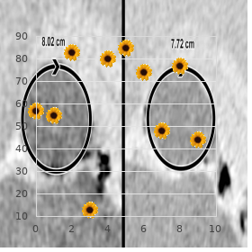 Lymphocytic infiltrate of Jessner