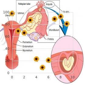 Gliosarcoma