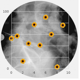 Deafness onychodystrophy dominant form