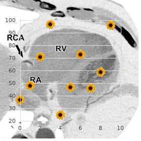 Infantile onset spinocerebellar ataxia