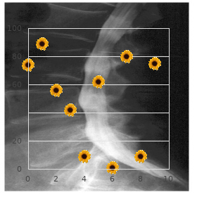 Chromosome 1q, duplication 1q12 q21