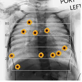 Nephrosis neuronal dysmigration syndrome