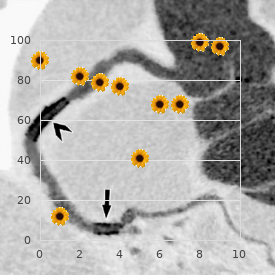 Coronal synostosis syndactyly jejunal atresia