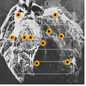 Mucoepithelial dysplasia