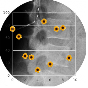 Polyostotic fibrous dysplasia