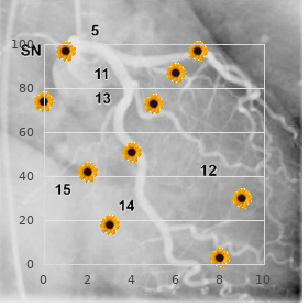 Micromelic dysplasia dislocation of radius