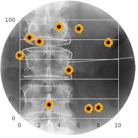 Acidemia, isovaleric