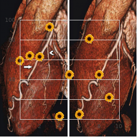 Peripheral T-cell lymphoma