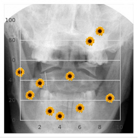 Van Den Bosch syndrome