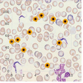 Jequier Kozlowski skeletal dysplasia