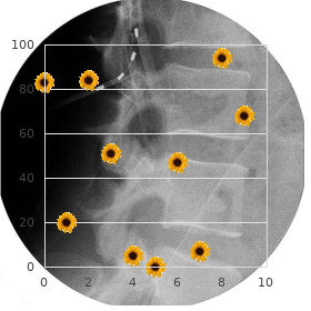 Situs inversus totalis with cystic dysplasia of kidneys and pancreas