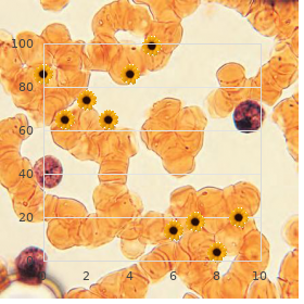 Urban Schosser Spohn syndrome