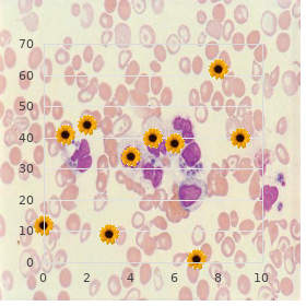 Respiratory distress syndrome, adult