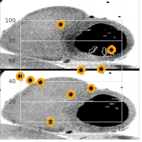 Macular degeneration, age-related