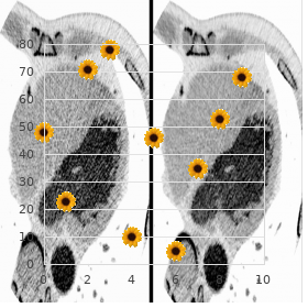 Benign familial infantile epilepsy