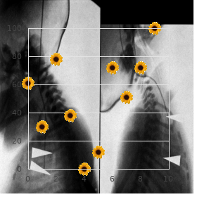 Chromosome 1 ring